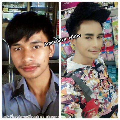 รูปผลการทำศัลยกรรมปากบาง ปากกระจับ